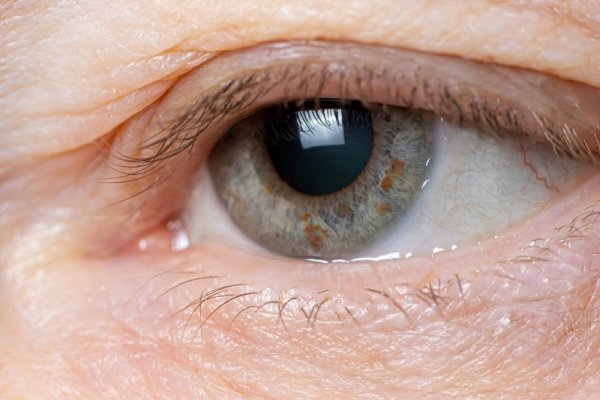 Göz Kapağı Düşmesi ve Göz Kapağı Düşüklüğü Ameliyatı