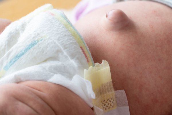 Bebeklerde Göbek Fıtığı: Belirtileri, Tedavisi